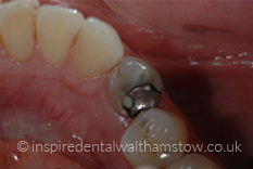 Amalgam Removals Before